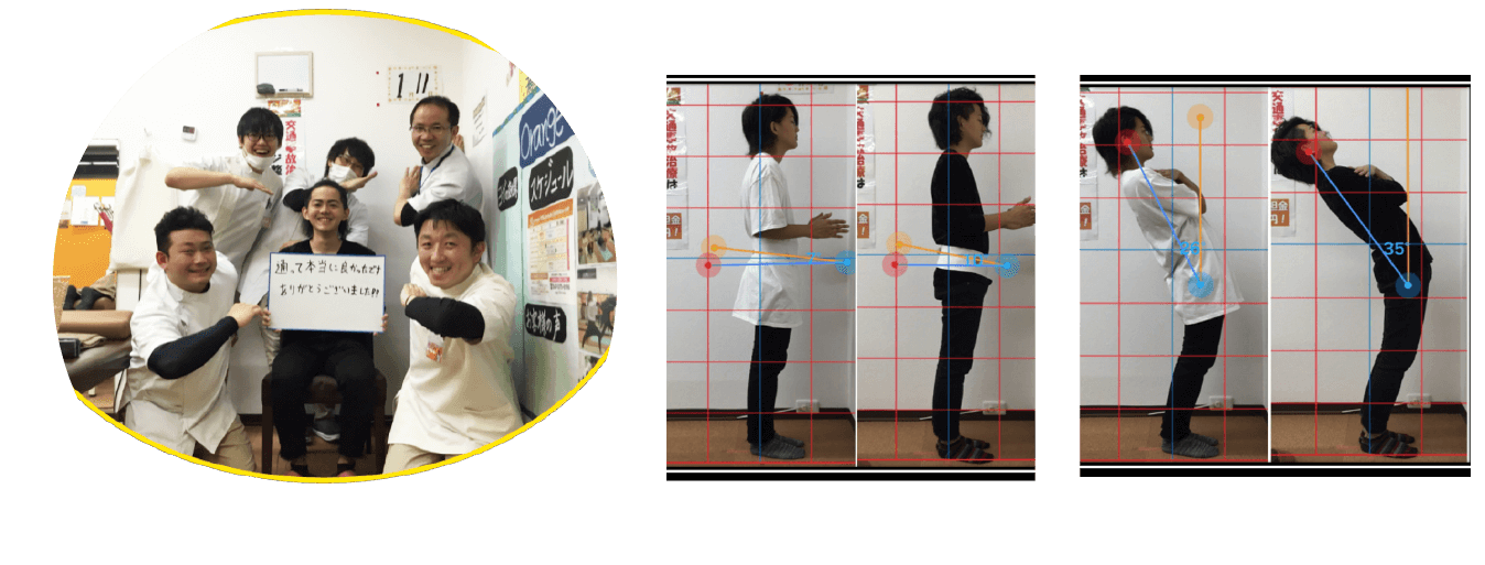ヘルニアが改善した患者様の写真と姿勢ビフォーアフター
